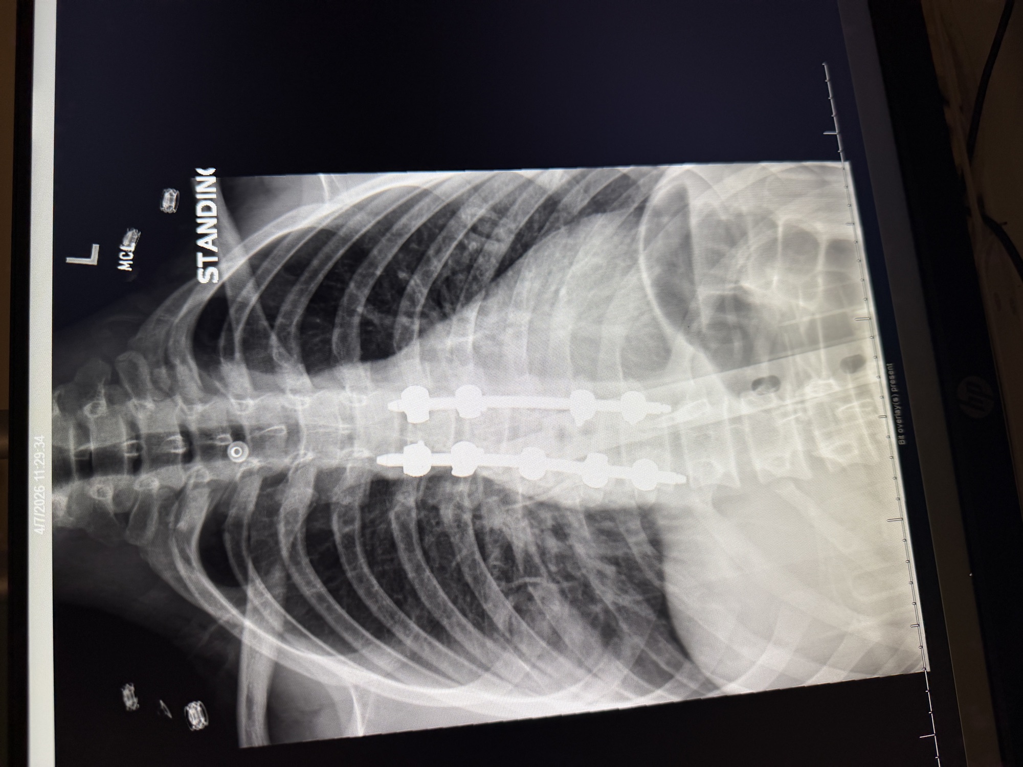 X-ray showing spinal fusion hardware